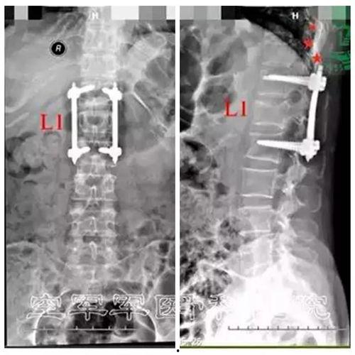 腰椎手术视频,从术前准备到术后康复