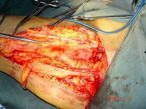 肿瘤手术全过程视频,直观展示医学奇迹