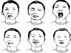 面瘫康复训练视频教程,全方位指导，轻松恢复微笑
